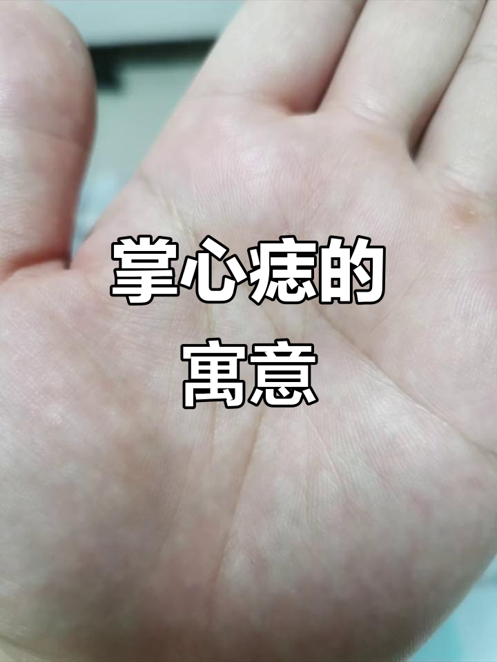 掌心痣象征着生命中的重要人物,你相信它的意义吗?