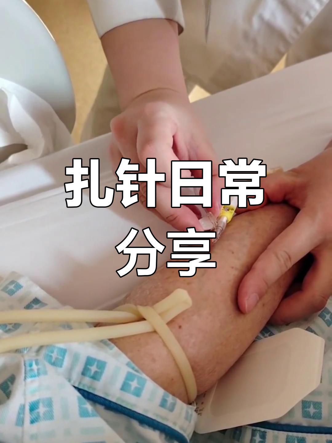 单手退针技巧与留置针操作