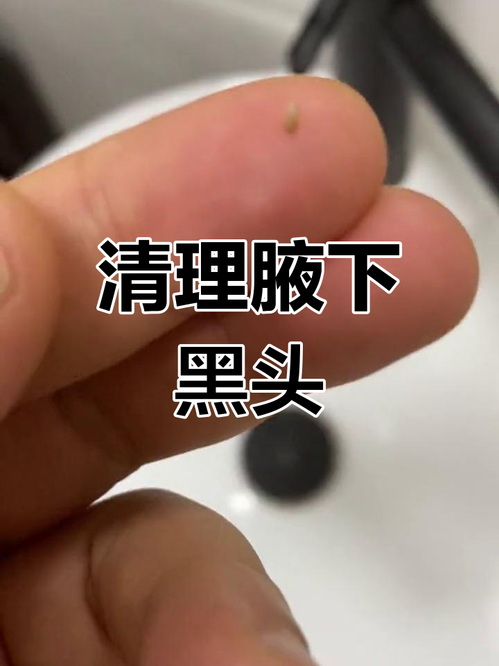 腋下黑头粉刺图片