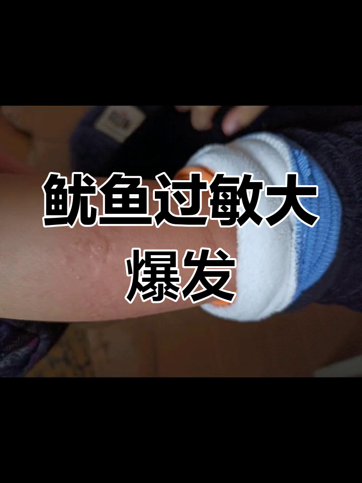 小宝吃鱿鱼过敏,浑身起疙瘩,太吓人了!