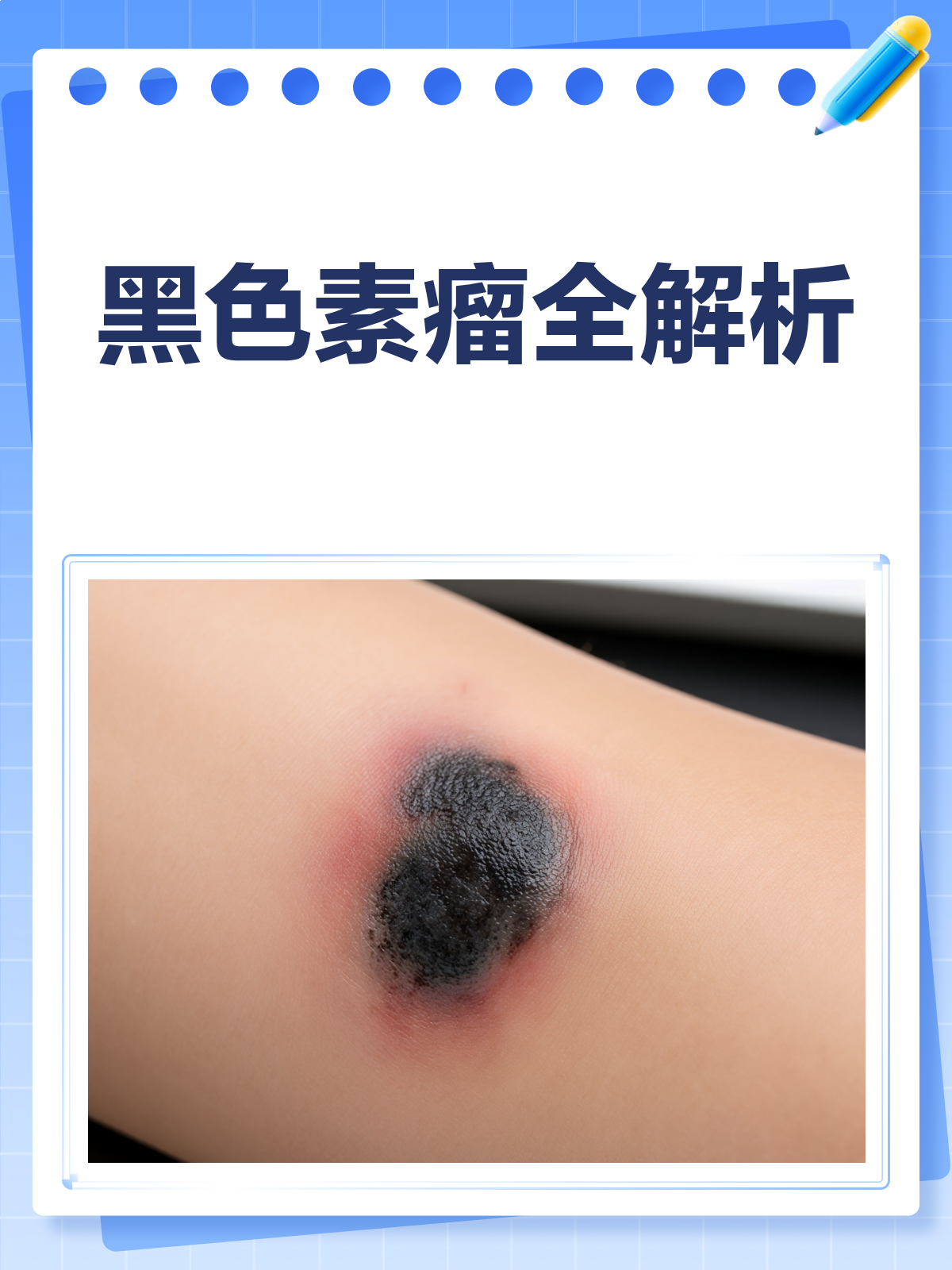 黑色素瘤知多少?皮肤科医生带你一探究竟!