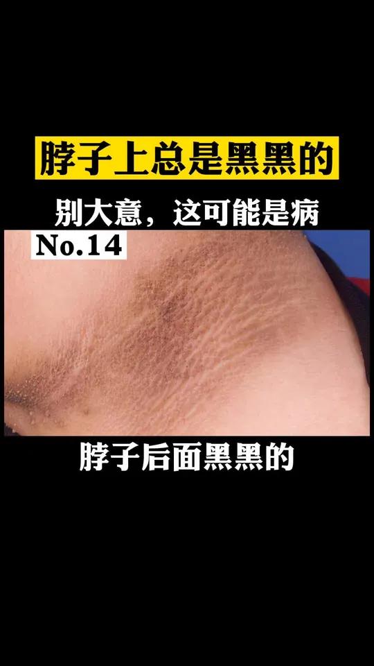 脖子上黑黑的,看起来很脏,怎么洗也洗不掉 这可能是黑棘皮病你可以试