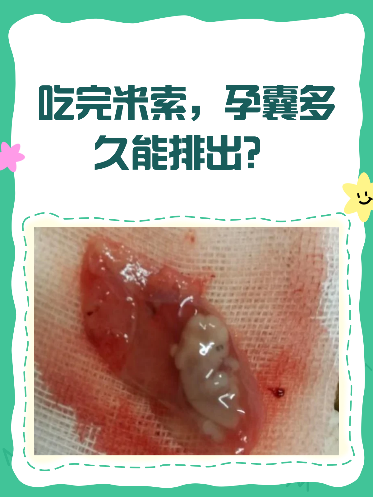 吃完米索,孕囊多久能排出?