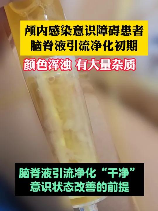 脑脊液外漏图片