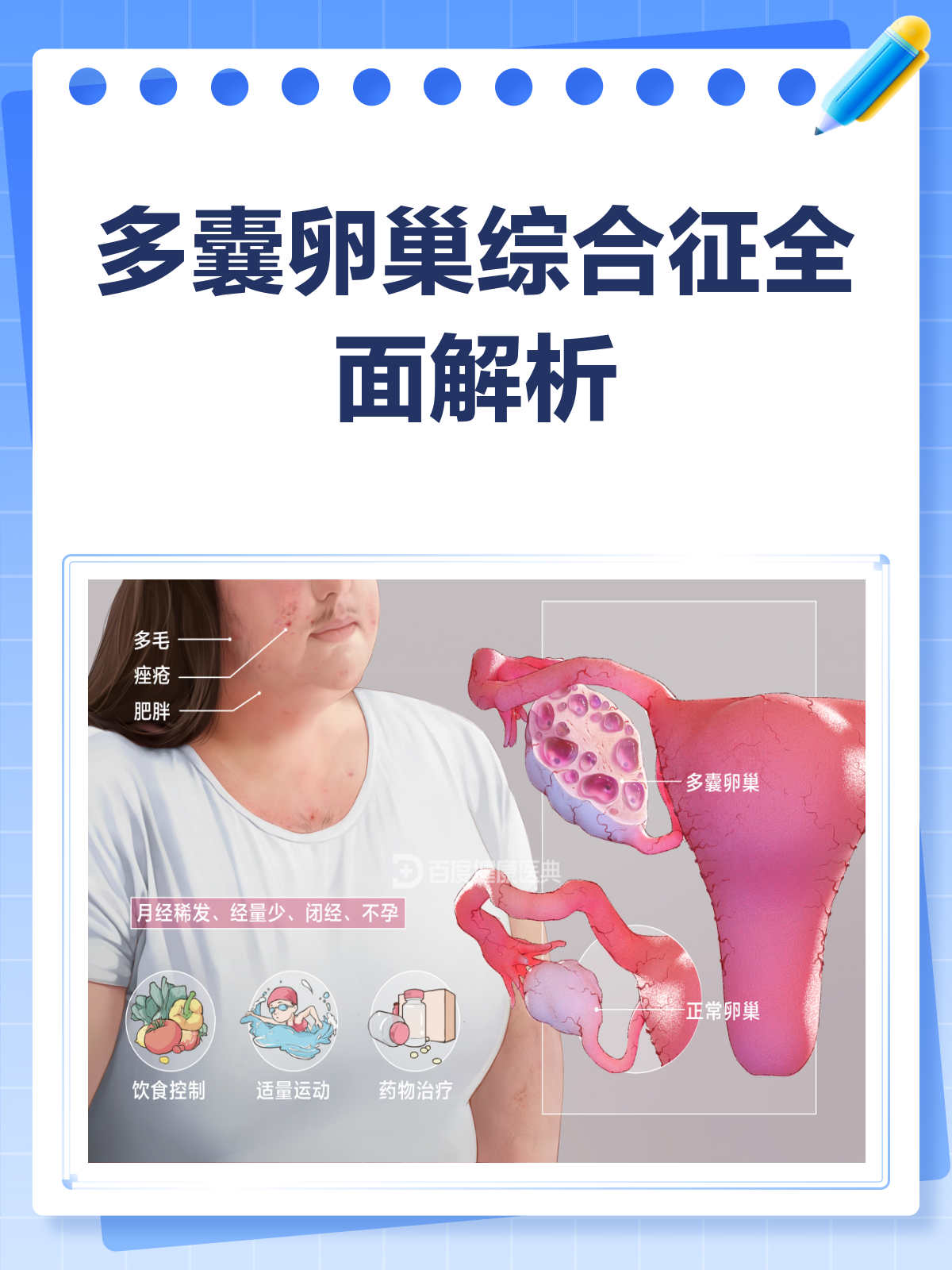 的卵巢多囊综合症_卵巢多囊综合症会癌变吗