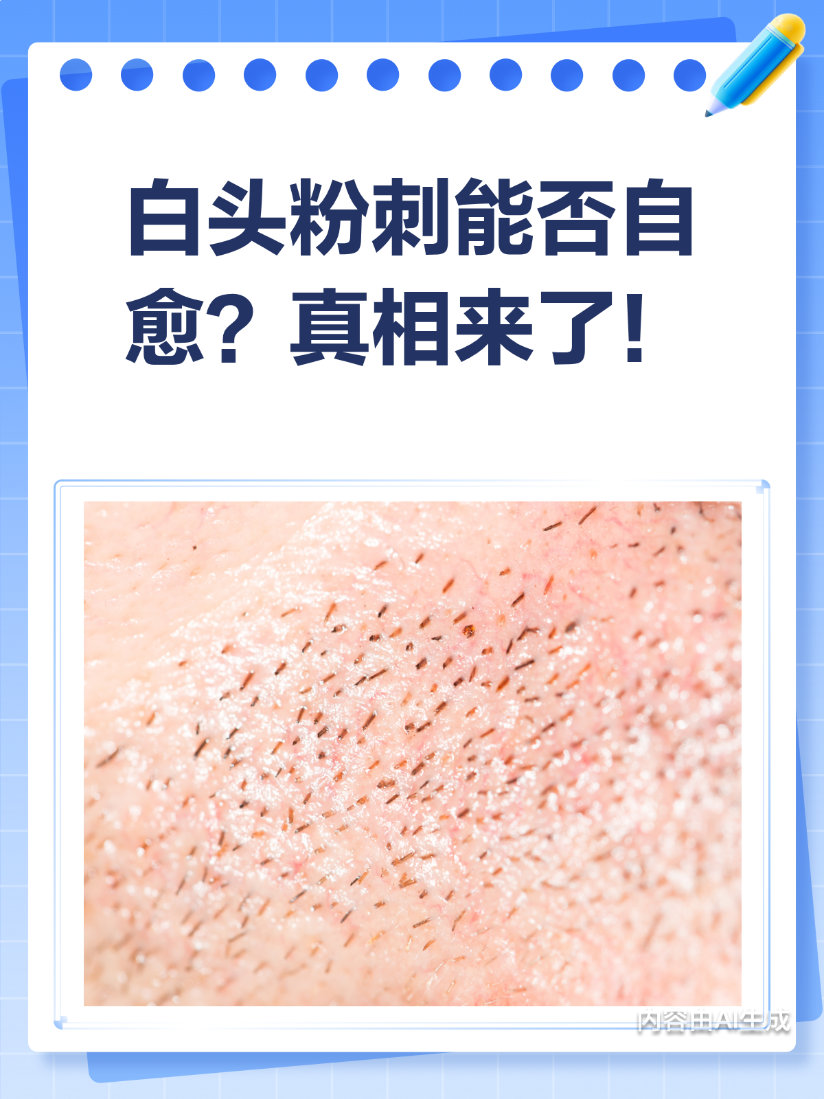 白头粉刺能自愈吗?看完这篇就懂了!