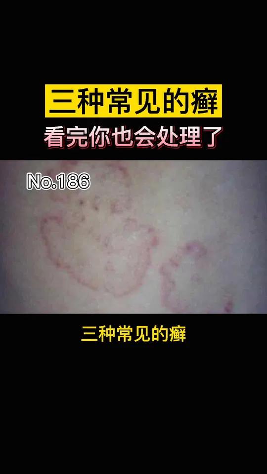 三种常见的癣,看完你也是半个皮肤科医生