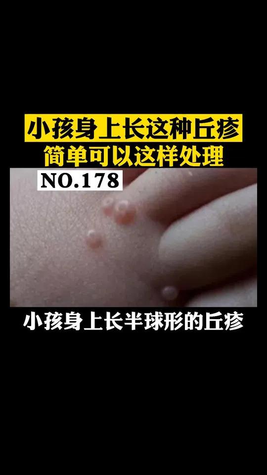 小孩身上长这种丘疹,中间还有一个小凹陷,这个是传染性软疣,可以试一