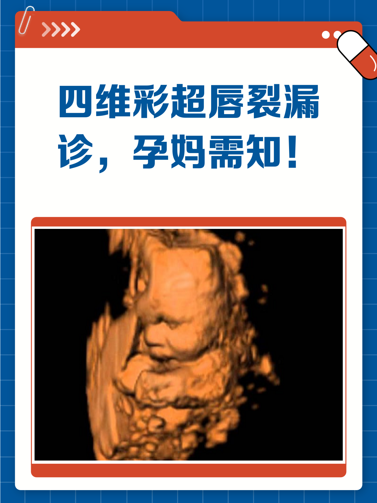 胎儿四维彩超会漏诊唇裂吗?