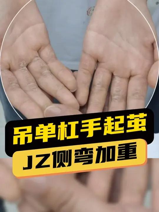 孩子吊单杠手起茧,脊柱侧弯还加重了,面对脊柱侧弯你还在让你家孩子