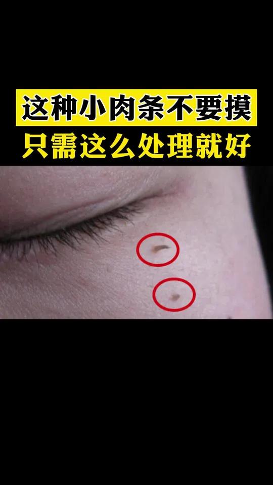 这种小肉条最喜欢长在脖子还有眼周