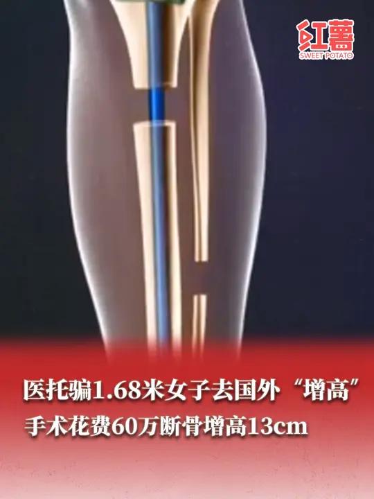 在我国,非医疗目的的肢体延长术(俗称断骨增高术),是被明令禁止的