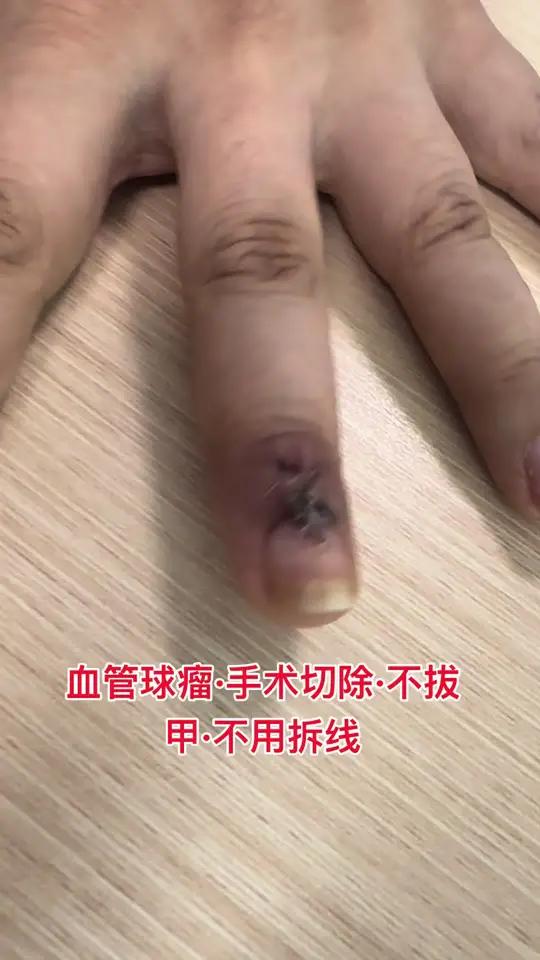 血管球瘤指甲疼痛 血管球瘤需要手术开窗,拔甲不能治疗血管球瘤