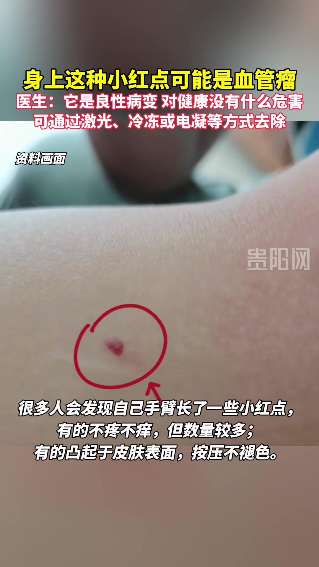 樱桃状血管瘤 血管瘤 病变