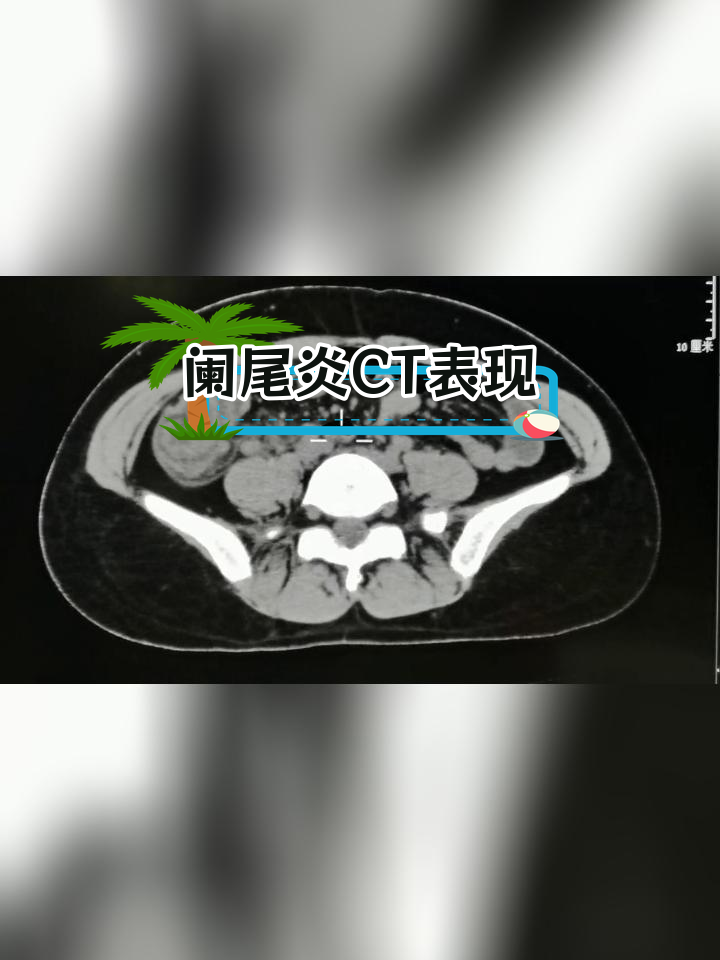 急性阑尾炎ct影像分析