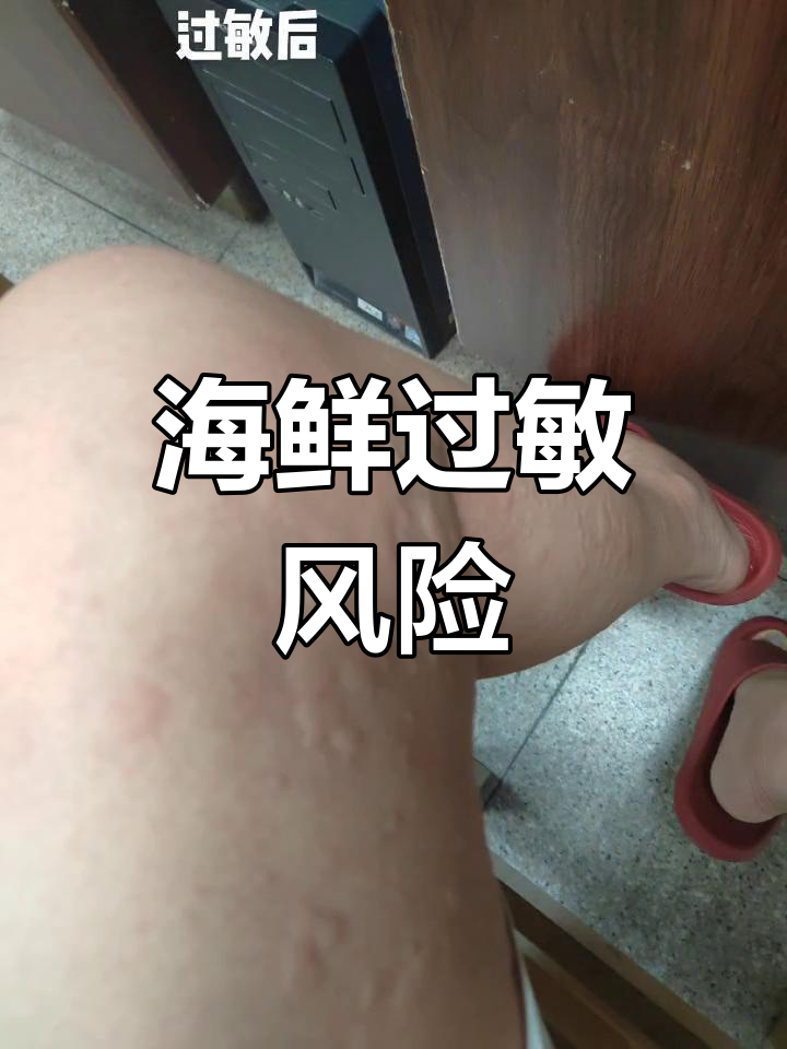 小龙虾虽美味,过敏者慎食,后果可能很严重!