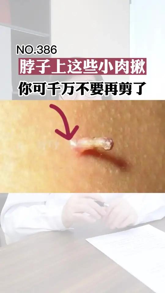 脖子上这样的小肉揪千万别剪,小心越来越多!