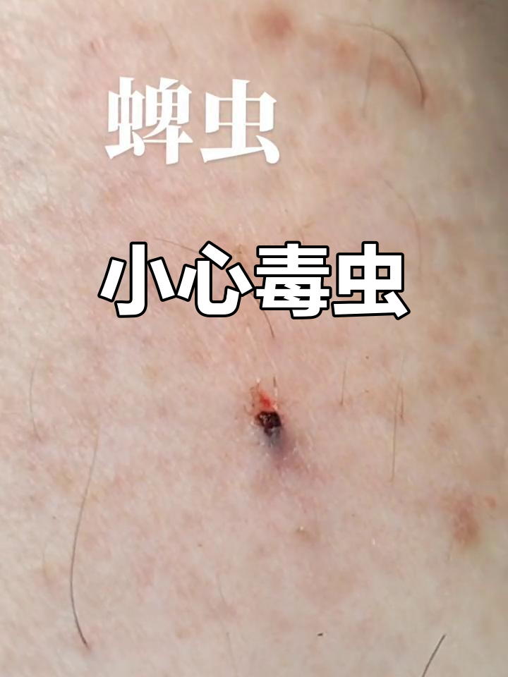 上山遇蜱虫,肉里钻进去吓一跳!