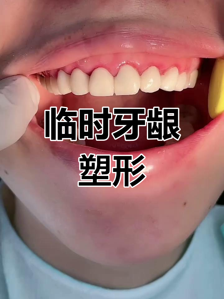 临时牙牙龈塑形,效果立竿见影