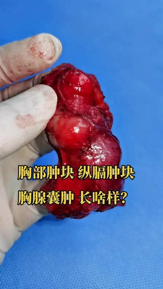胸部肿块 胸部结节 纵膈肿块胸腺囊肿长什么样?
