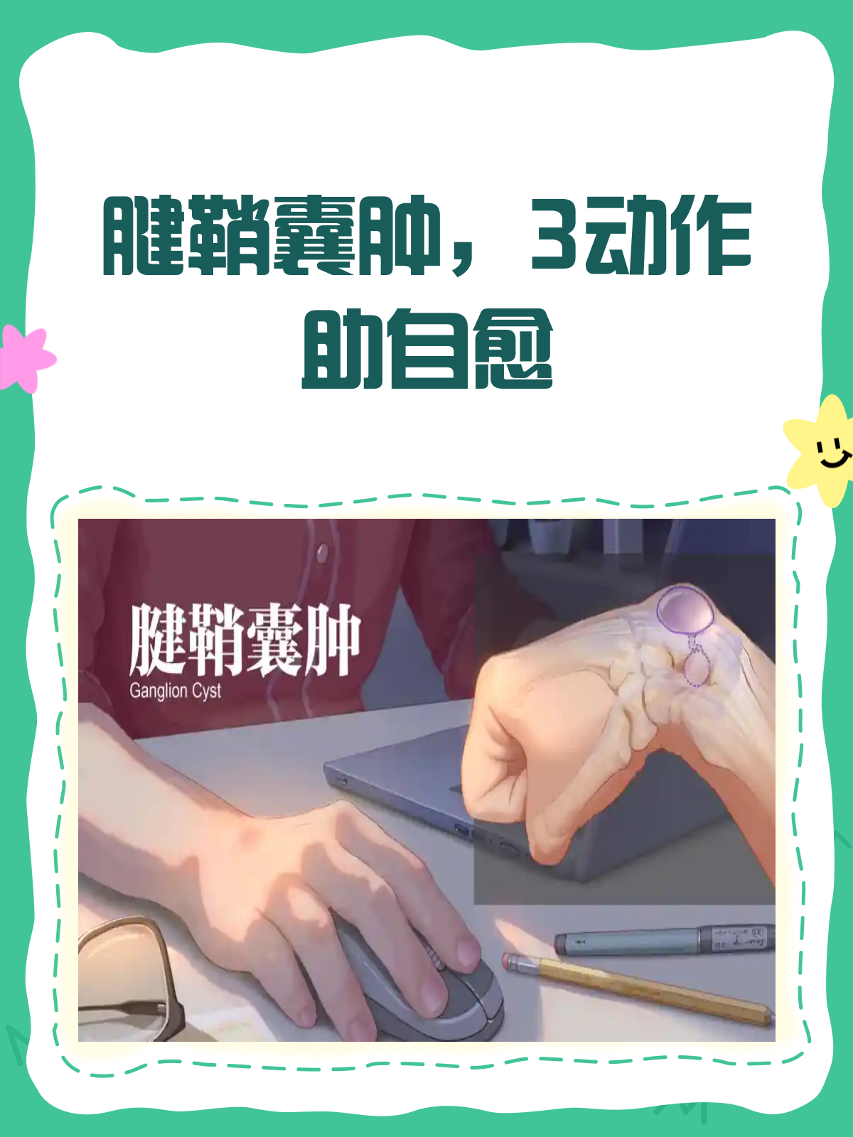 腱鞘囊肿别烦恼!3个动作助你缓解