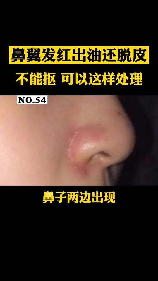 鼻子两边经常发红,爱出油,有时候痒痒的还会脱皮,这是脂溢性皮炎这样