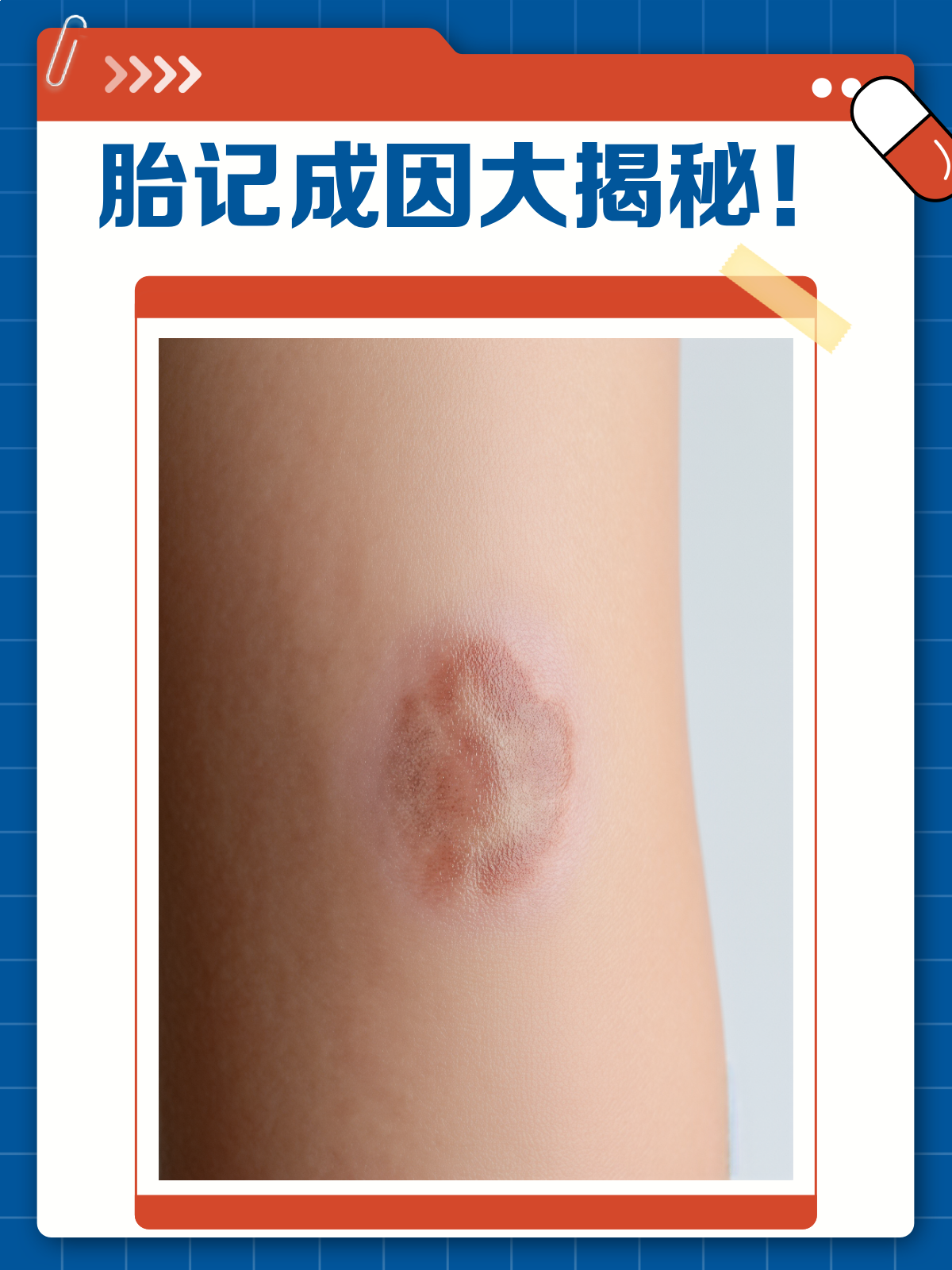 为什么会有胎记筛查为什么在线