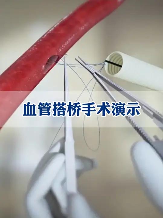 搭桥手术是如何链接人工血管的 搭桥手术 血管堵塞 脑血管病专家汪雷
