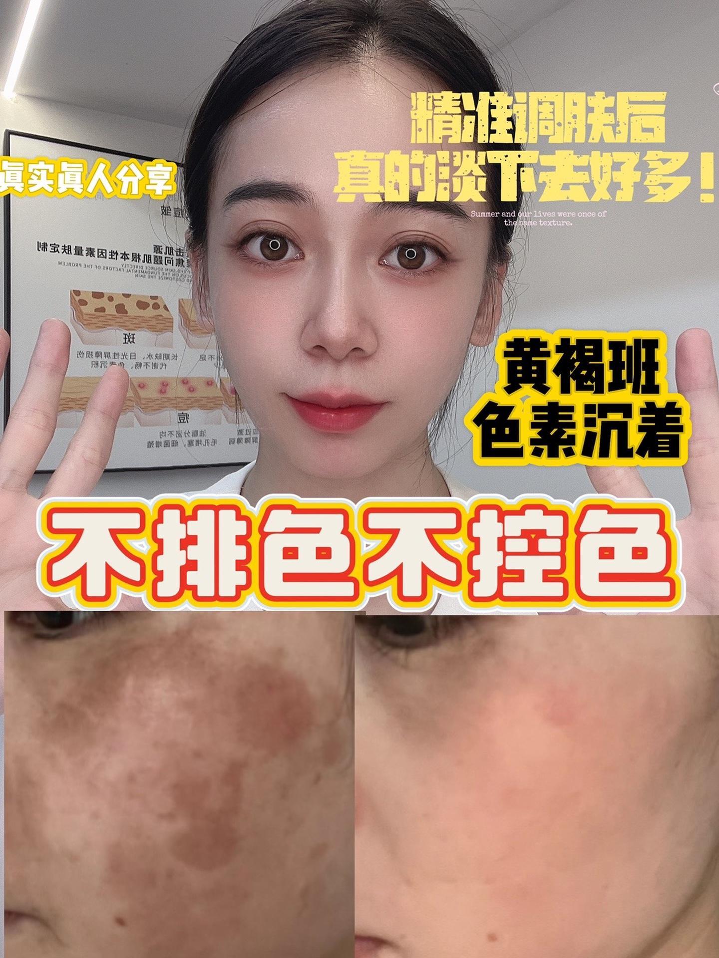 真实分享祛斑后反黑丢掉排色控色后皮肤更好了
