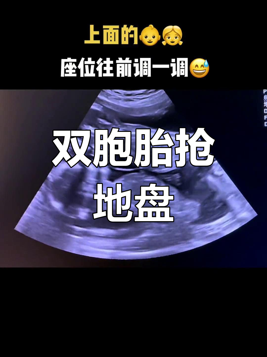 双胞胎在妈妈肚子里争地盘,萌态十足!
