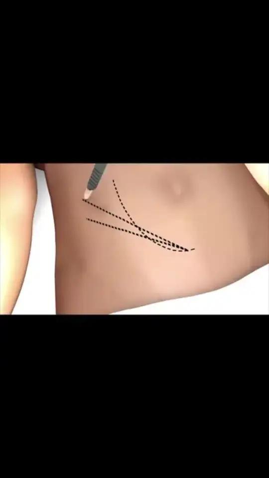 肾移植并不是把肾放在人体肾脏所在位置哟,一般放在髂窝内的,具体手术