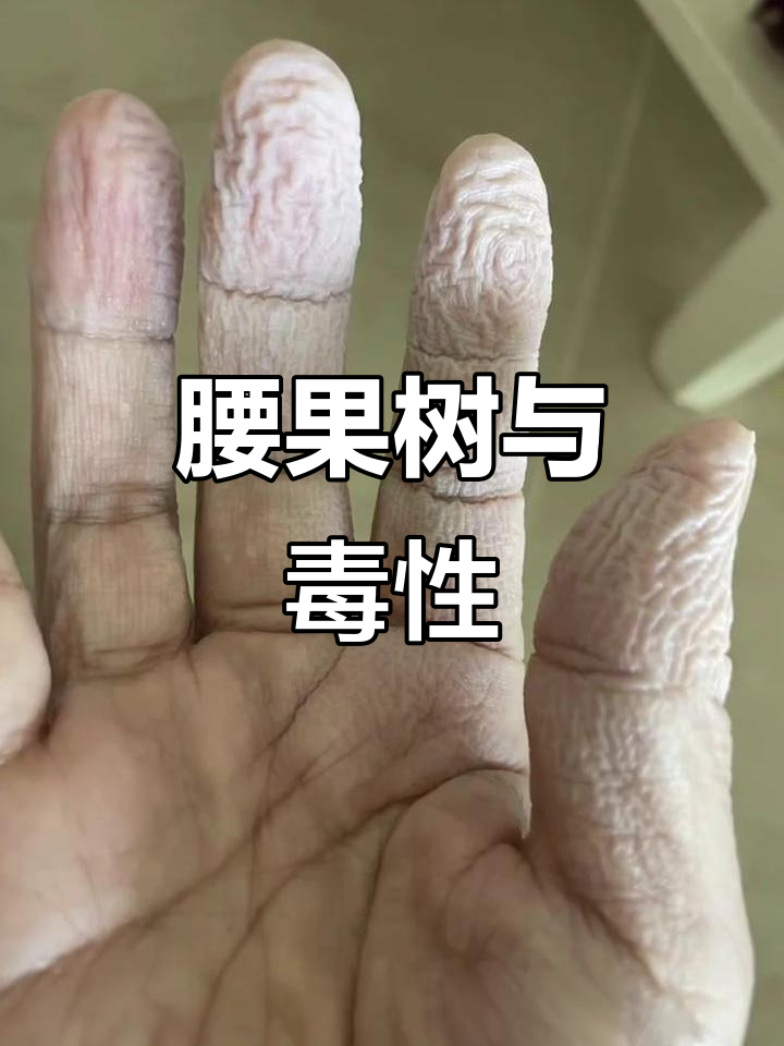腰果外皮有毒,处理需谨慎!