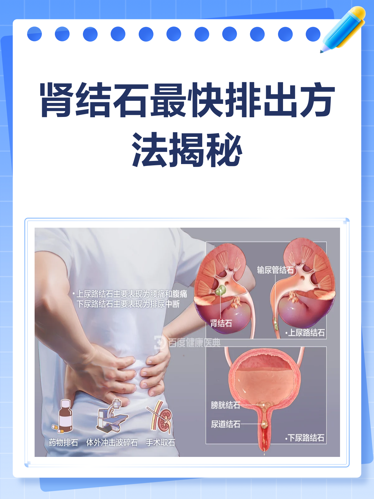 肾结石怎么排最快?这些方法帮你速战速决!