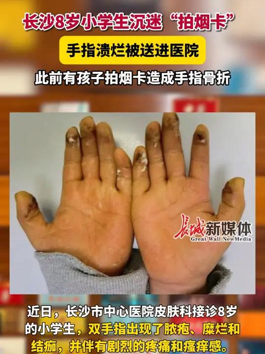 此前有孩子拍烟卡造成手指骨折.8岁男童拍烟卡致手指溃烂 烟卡