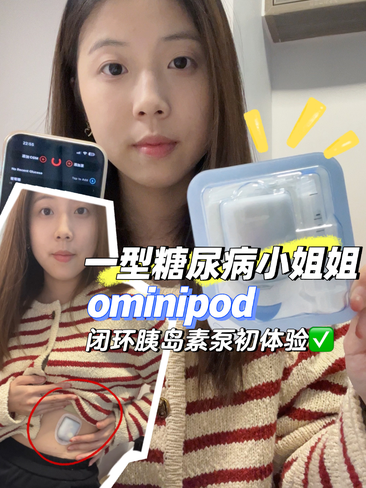 一型糖尿病小姐姐omnipod胰岛素泵+闭环佩戴