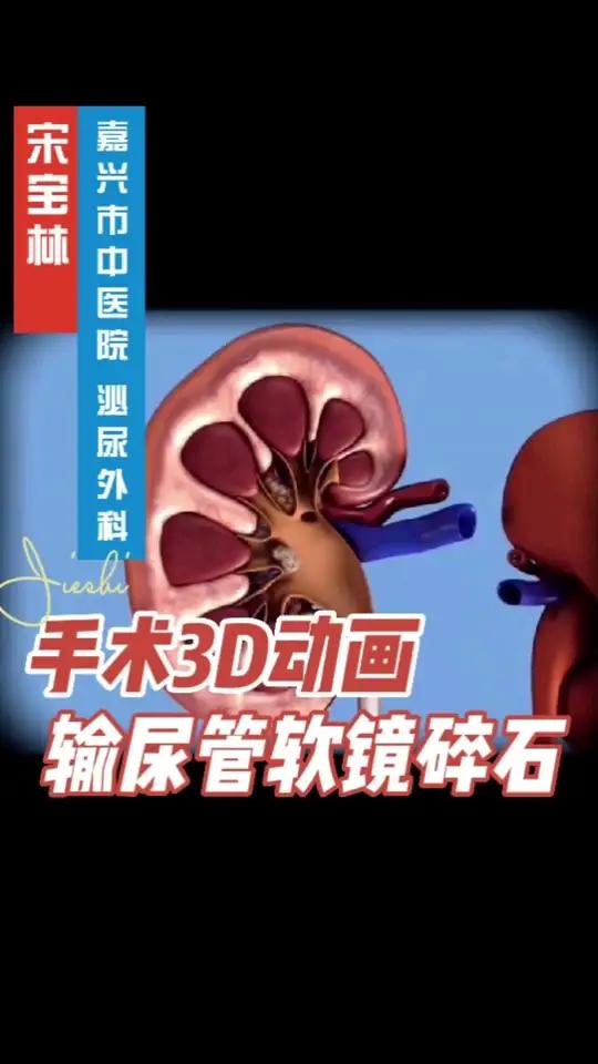 输尿管软镜钬激光碎石手术3d演示.得了肾结石怎么办?肾结石微创手术