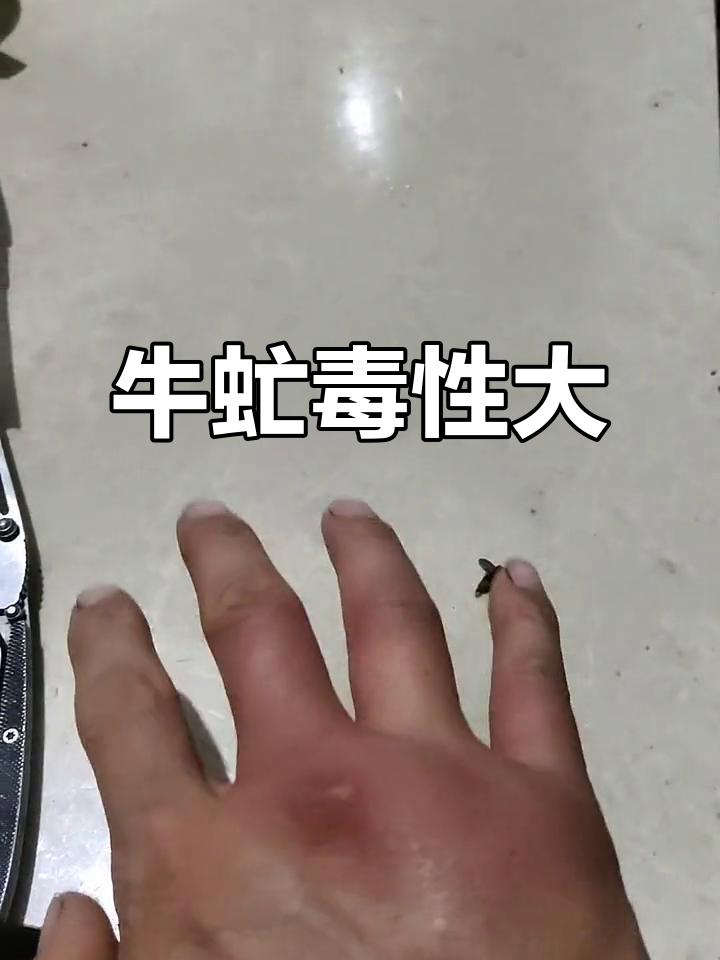 牛虻咬人真疼,毒液厉害不容忽视