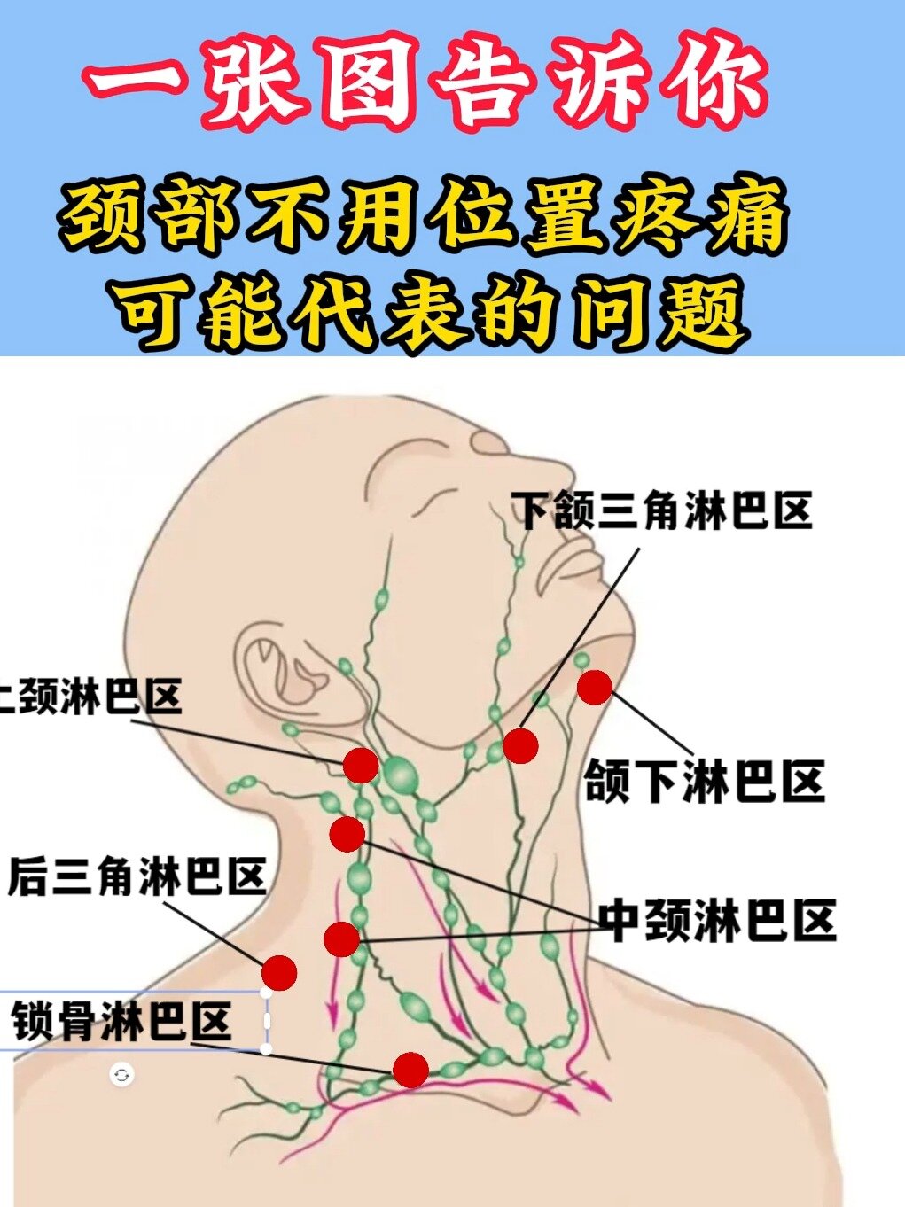 一张图告诉你,颈部不同疼痛代表着什么症状