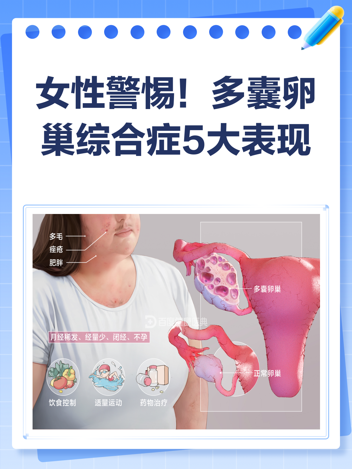多囊卵综合征_多囊卵综合征的症状什么意思