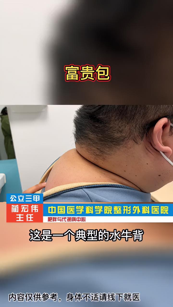 富贵包,满月脸,水牛背,是医学生熟知的一个病症的表现 病态性肥胖