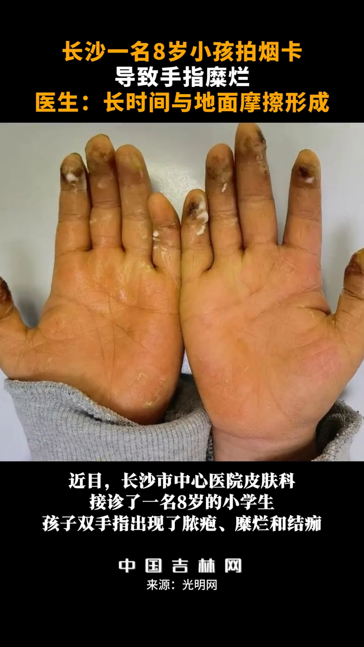 8岁小孩拍烟卡导致手指糜烂,医生:长时间与地面摩擦形成