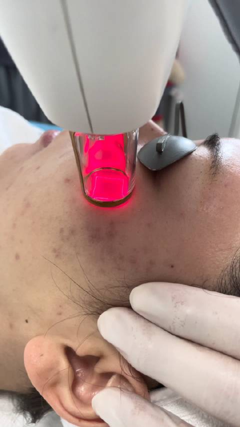 1565nm非剥脱点阵激光 能有效改善皮肤粗糙,毛孔粗大,痘印,细纹,出油