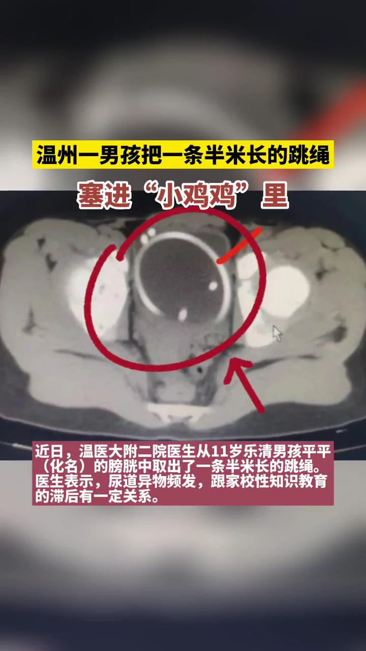 温州一男孩竟把一条半米长的跳绳塞进"小鸡鸡"里,医生说类似病例还不