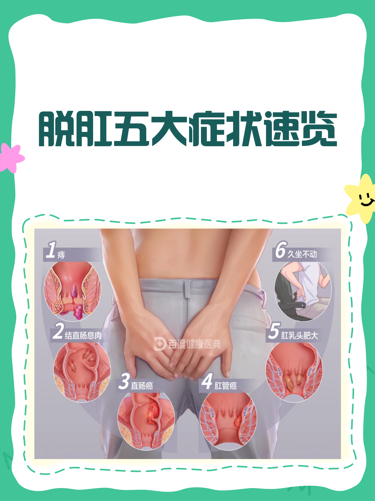 脱肛那些事儿,症状全揭秘!
