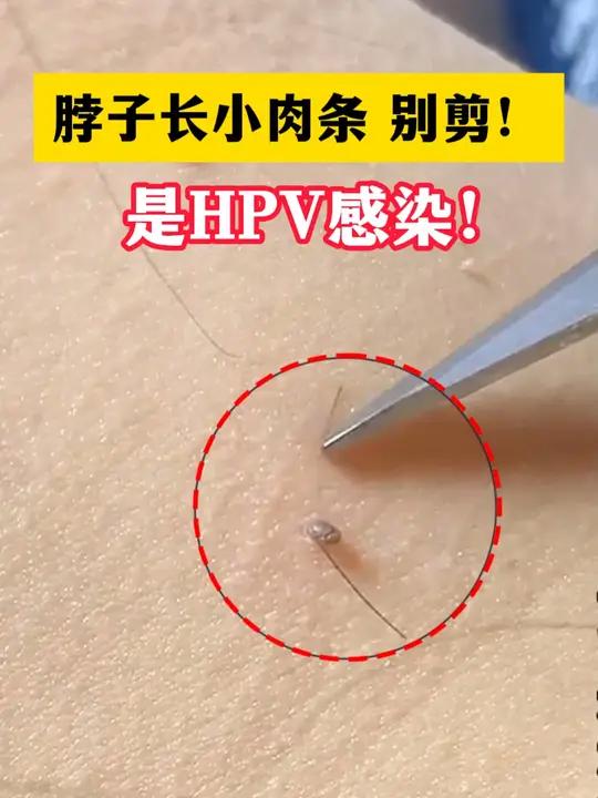 女性脖子上长粗糙的小肉条,别剪!当心是hpv病毒感染!