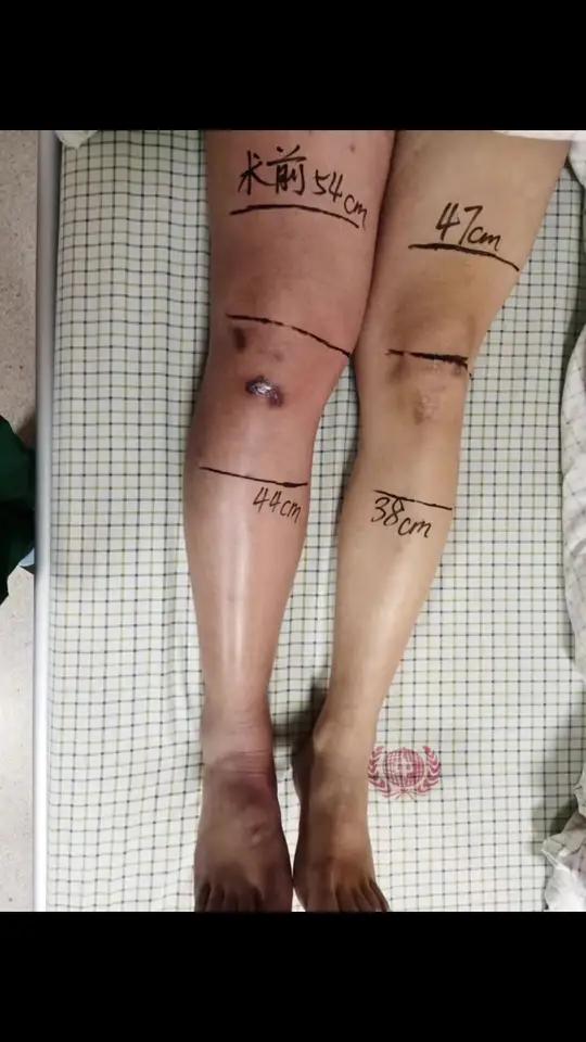 41岁壮年男性,右膝关节骨折40天后突发右下肢肿胀,股青肿,看这心率