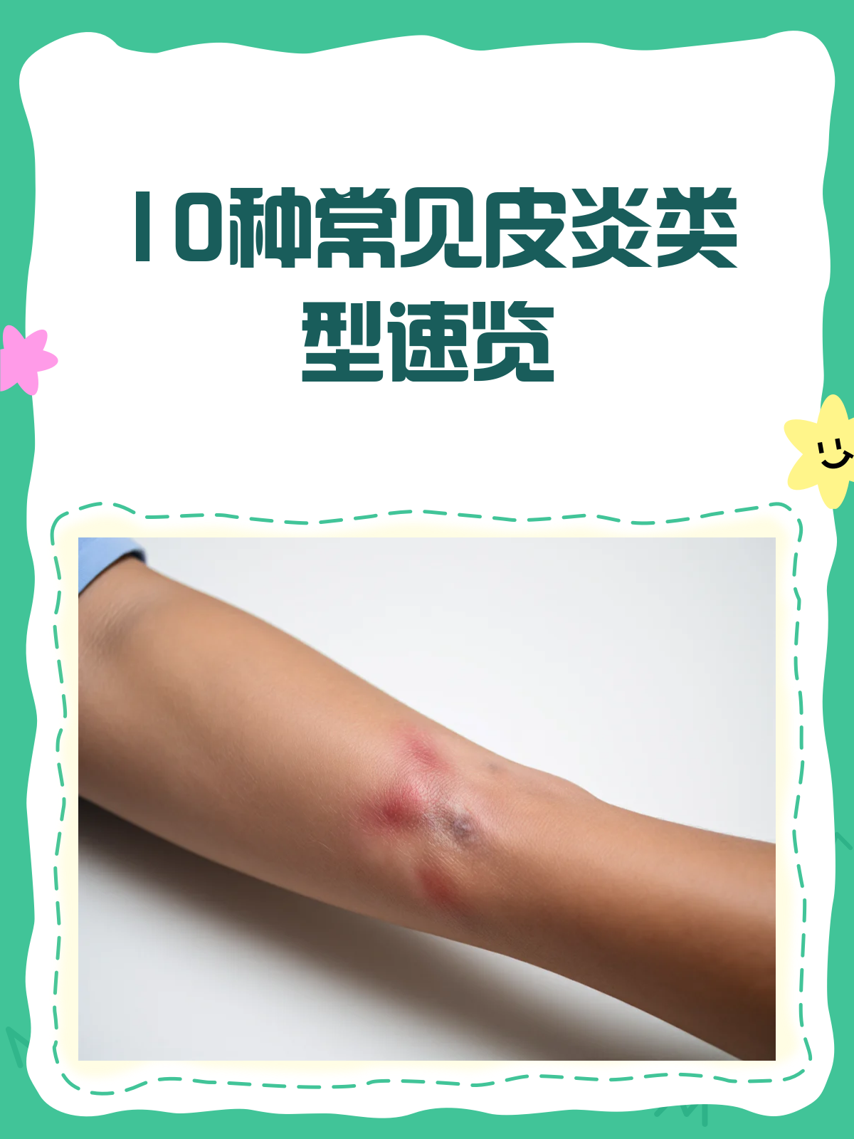 为什么会得皮炎?为什么在线 为什么会得皮炎?为什么在线