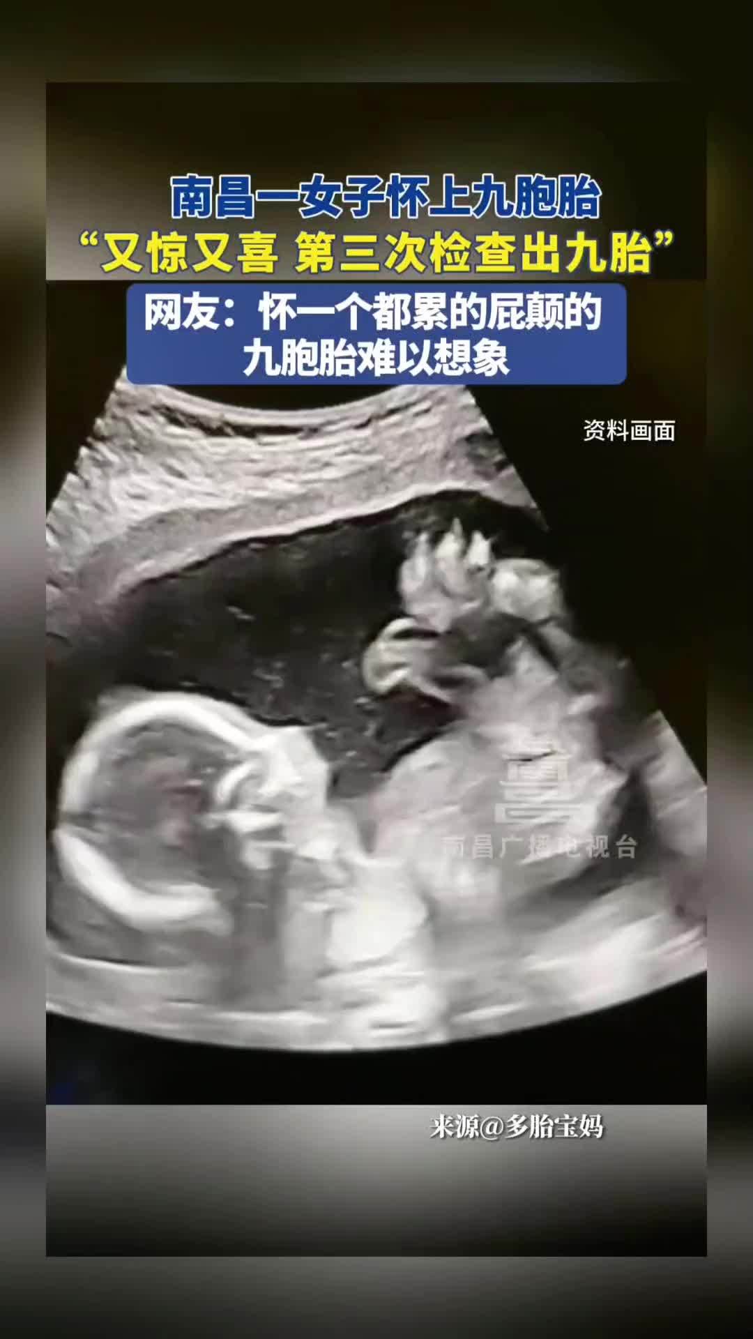 又惊又喜 南昌女子怀上9胞胎