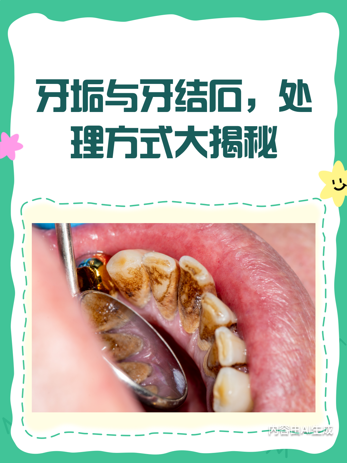 牙结石vs牙垢,别再傻傻分不清啦!