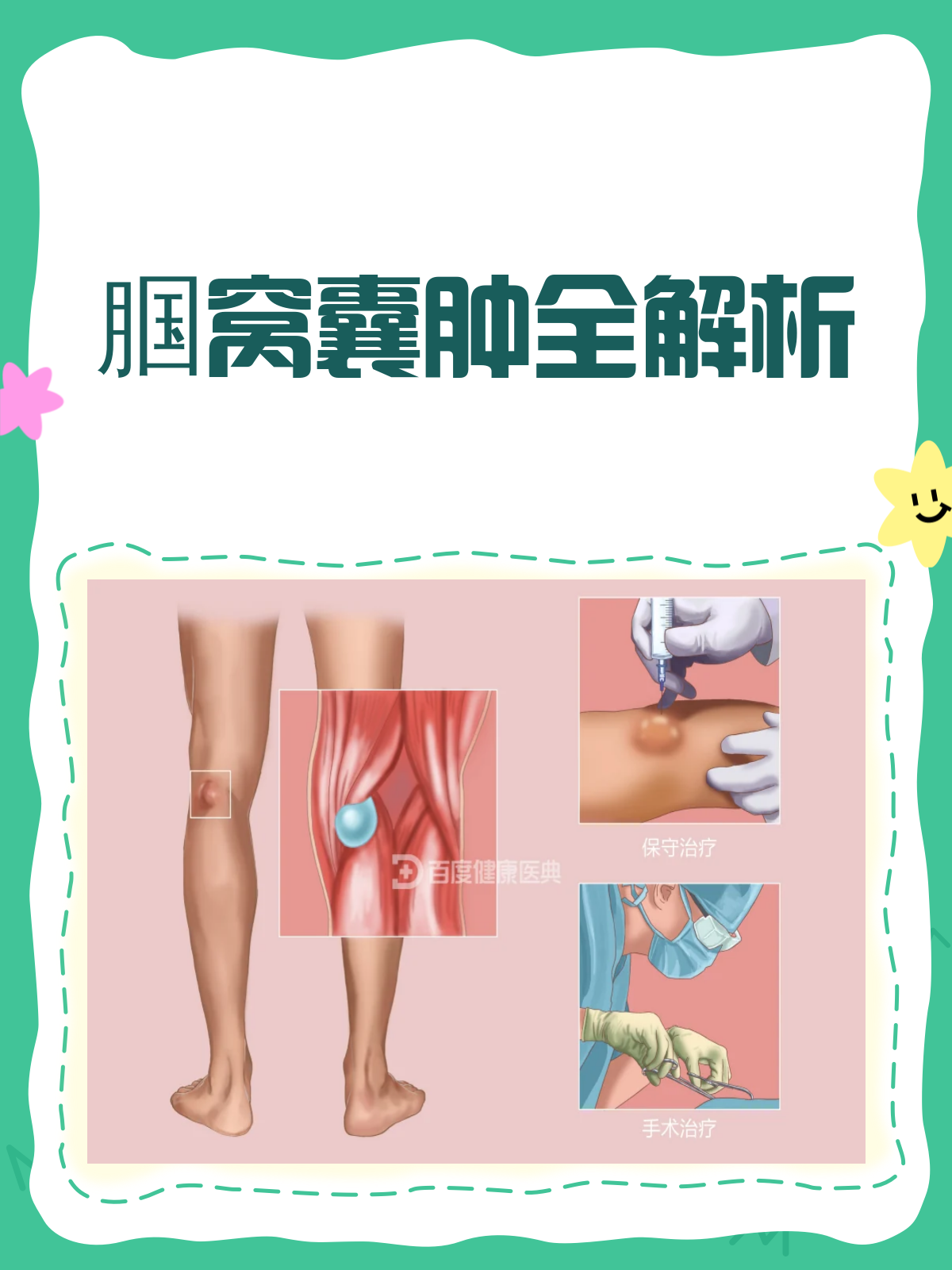 腘窝囊肿知多少?膝盖后的"小包"不简单!